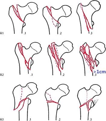 A sophisticated fracture classification system of the proximal femur trochanteric region (AO/OTA-31A) based on 3D-CT images